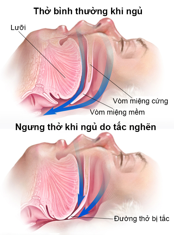 hoi chung ngung tho khi ngu 1