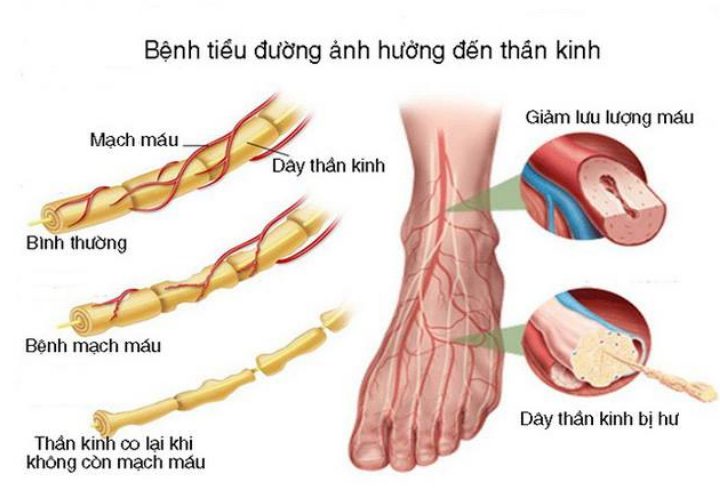 đau thần kinh do tiểu đường