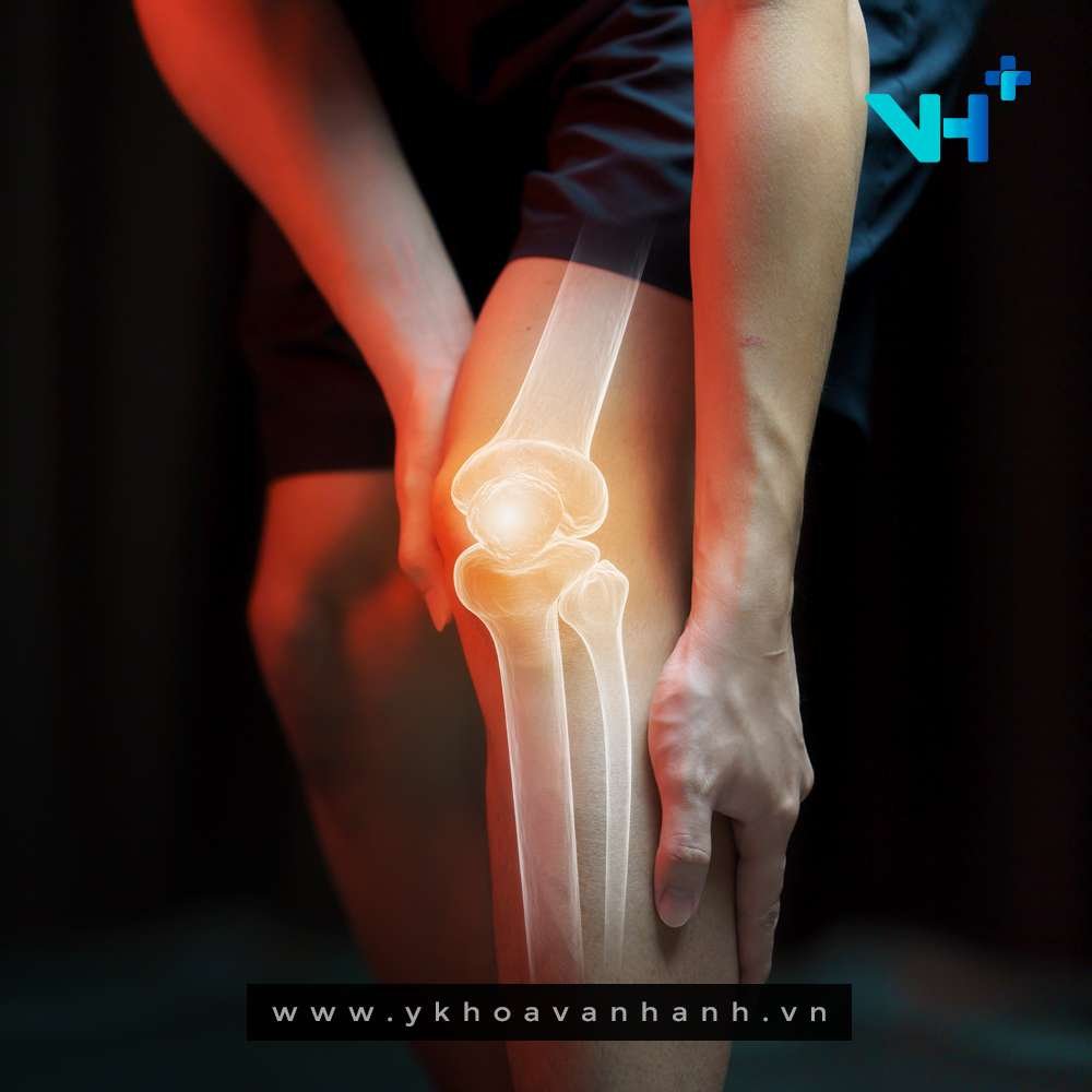 triệu chứng thoái hóa khớp gối cần biết