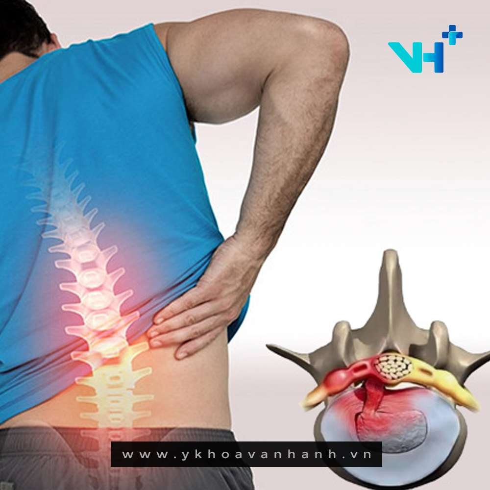 các giai đoạn của thoát vị đĩa đệm