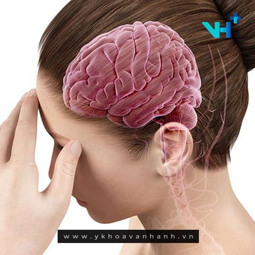 dấu hiệu tai biến mạch máu não nhẹ