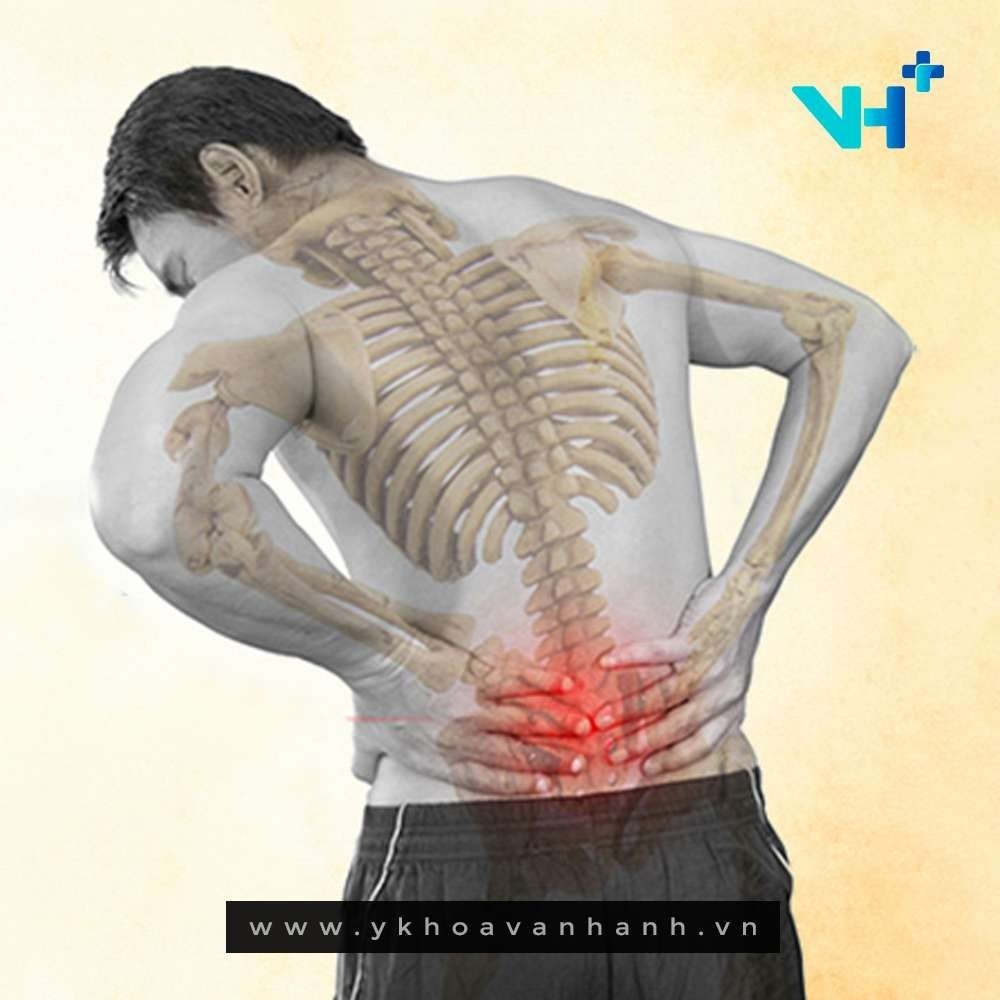 Người bị đau lưng có nên chạy bộ không