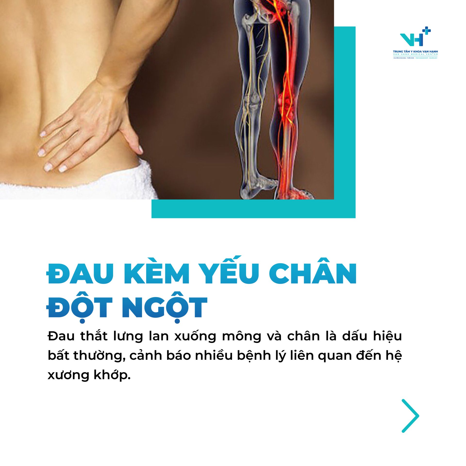 5 dấu hiệu đau lưng báo hiệu thoát vị đĩa đệm chèn ép dây thần kinh