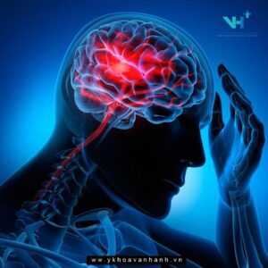 Những ai nên tầm soát đột quỵ?