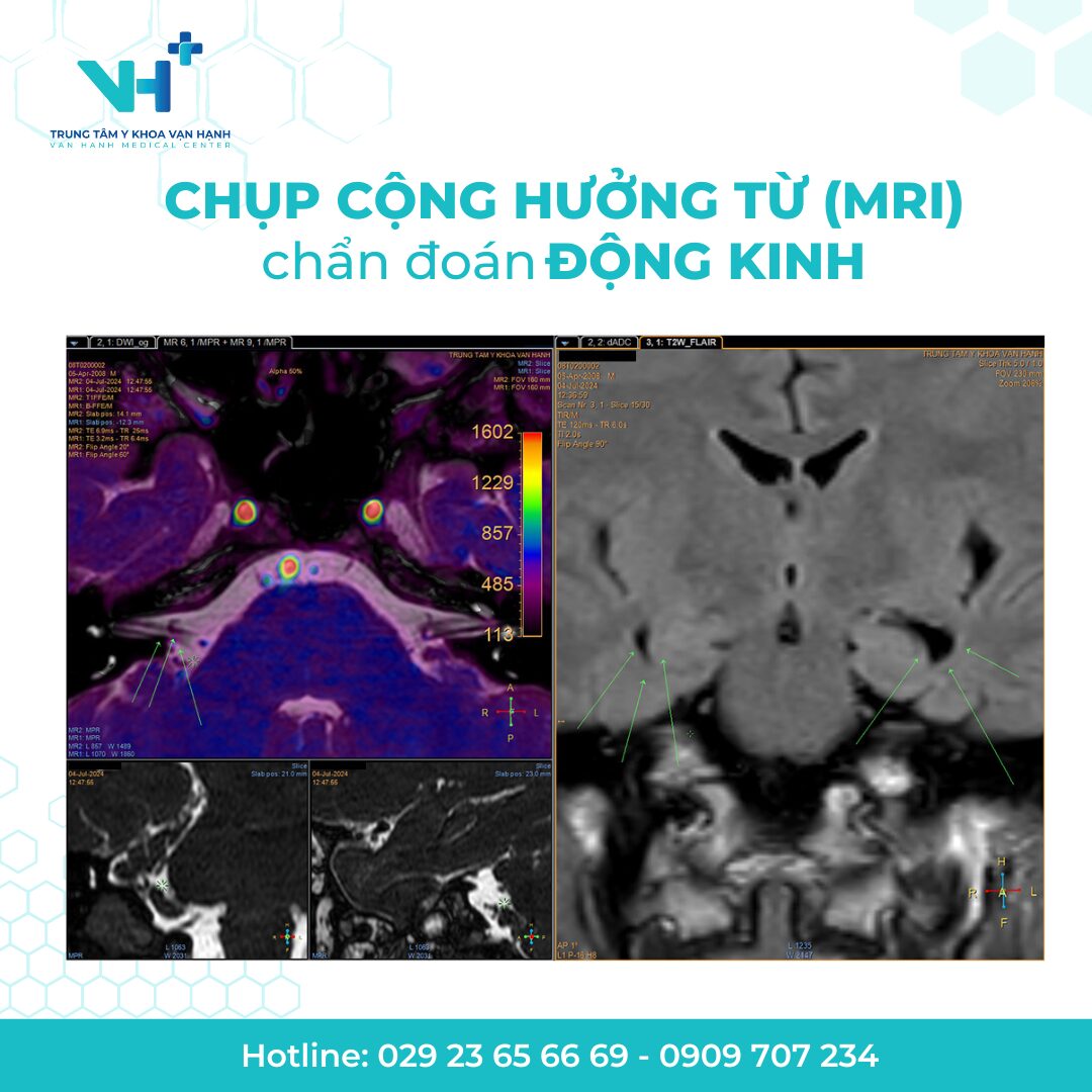 Chụp cộng hưởng từ (MRI) chẩn đoán động kinh